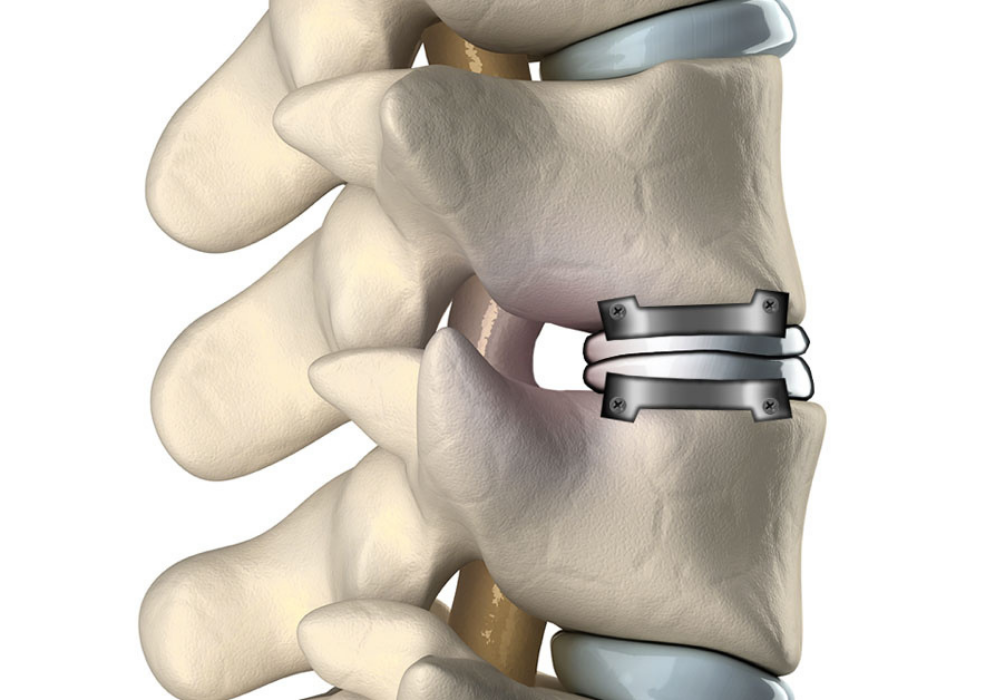 cervical disc replacement