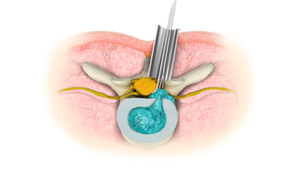 Minimally Invasive Spine Surgery