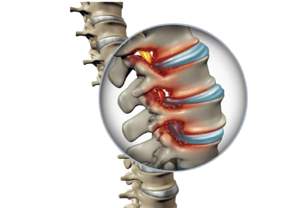 Spinal Stenosis