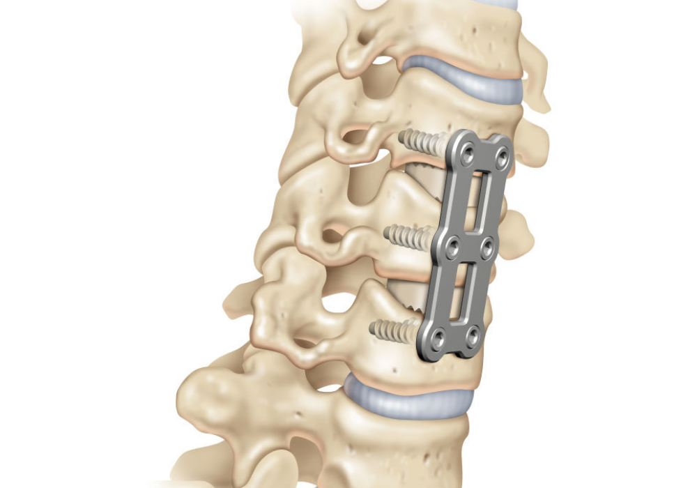 cervical disc replacement