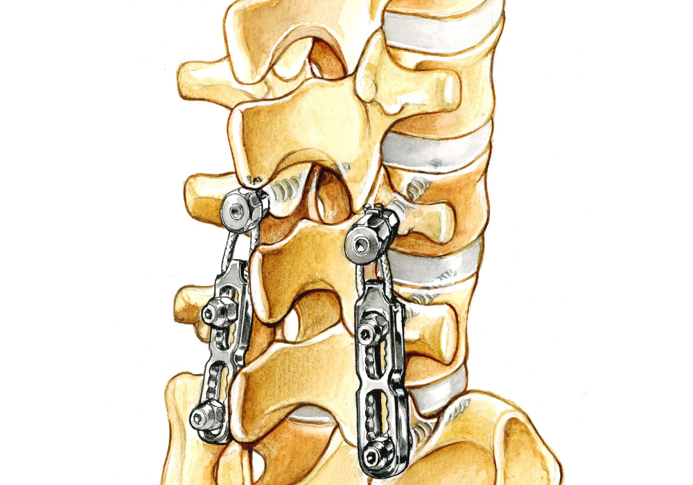 cervical spine surgery