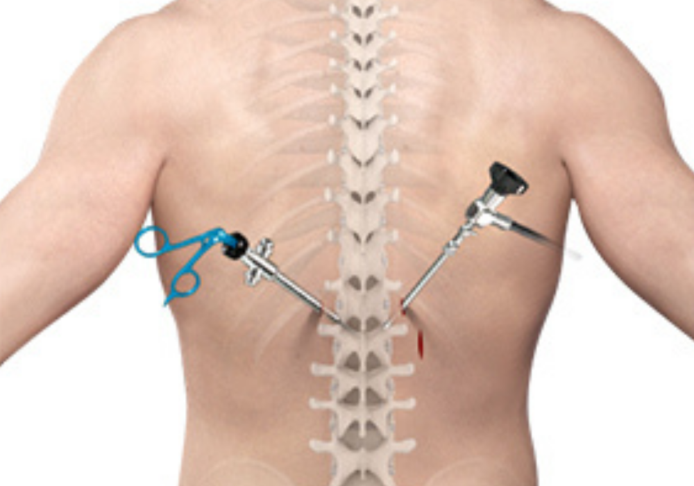 Minimally Invasive Spine Surgery