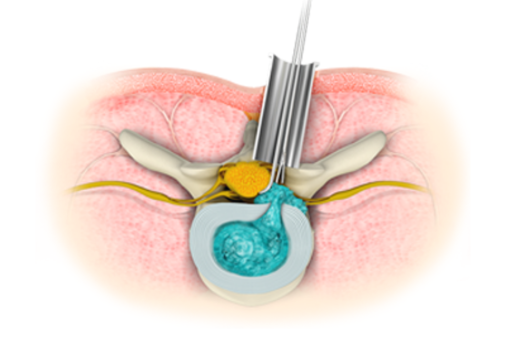 Minimally Invasive Spine Surgery