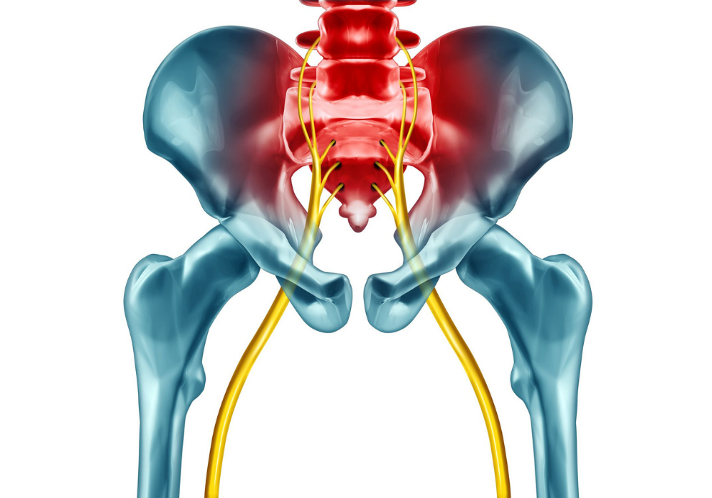 Sciatica