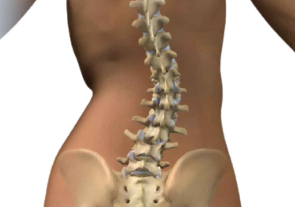 Scoliosis